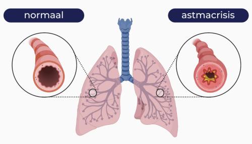 Astma & Sport