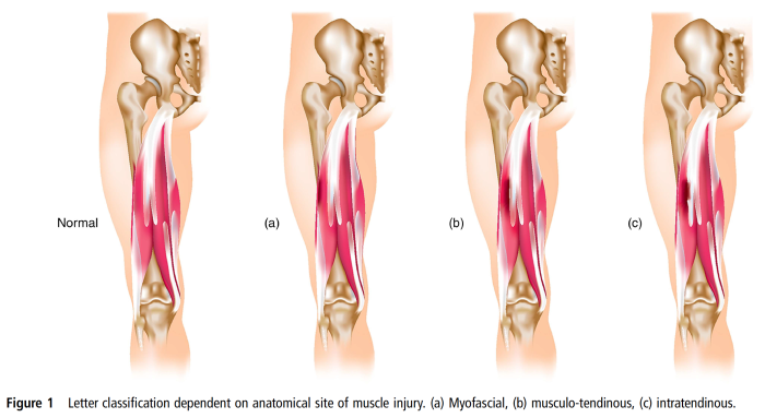 Muscle injury