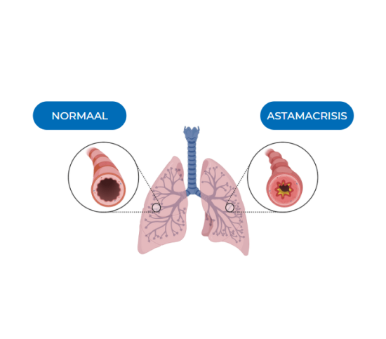 Wat is astma